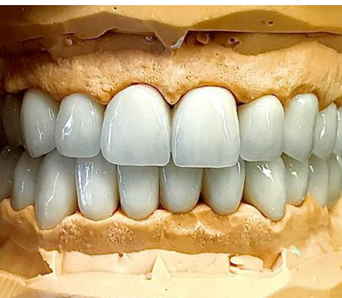 CAD-CAM İmplant Zirkon Porselen Kuron