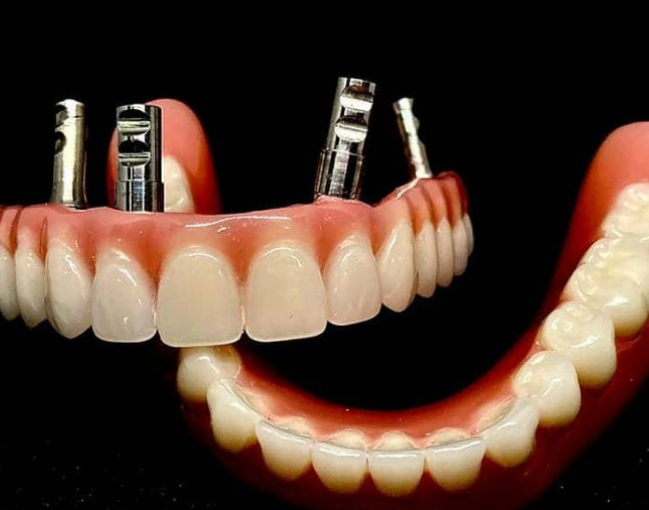 All On Four Total Bitim+İskelet Döküm+Diş